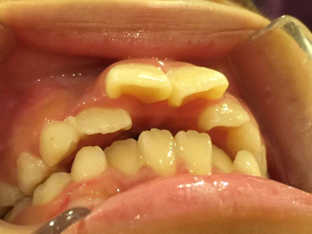 手机拔牙游戏_牙小游戏_龅牙玩手机游戏