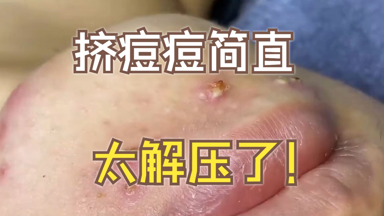 挤痘痘的手机游戏_挤痘痘游戏叫什么名字_按键手机游戏扎痘痘